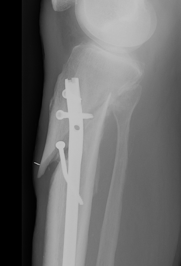 Proximal Tibial Fracture Poorly Nailed